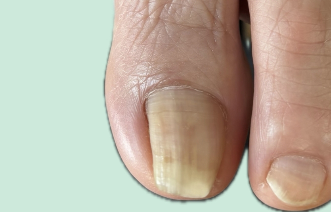 爪再生サポートケア