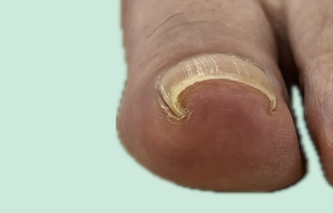 爪再生サポートケア