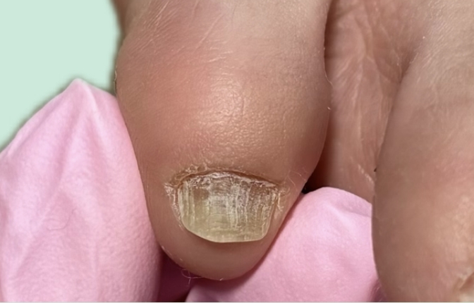 爪再生サポートケア