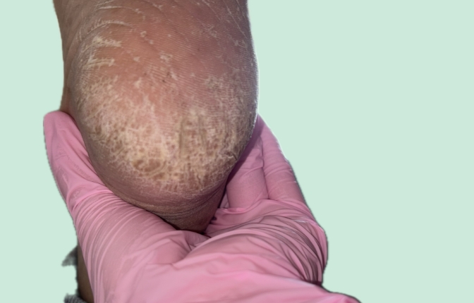 爪再生サポートケア